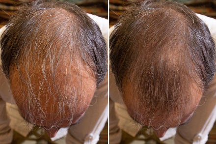 Hair Loss Treatment Result Before & After