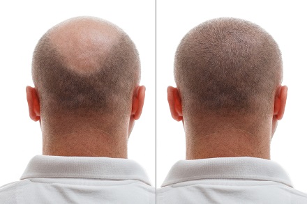 Hair Loss Treatment Result Before & After